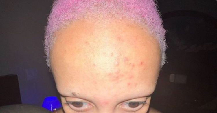 Doja Cat Shows Off Head Acne In New Selfie :: Hip-Hop Lately